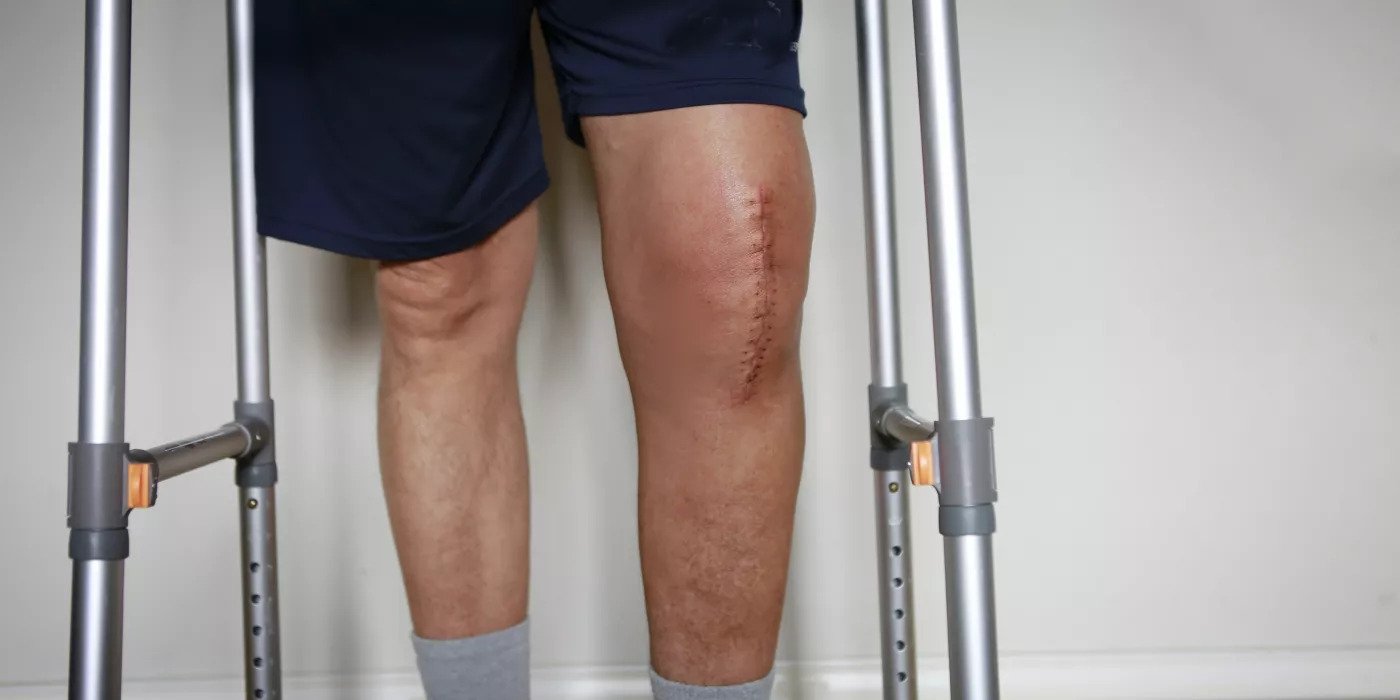 Defective Knee Replacement